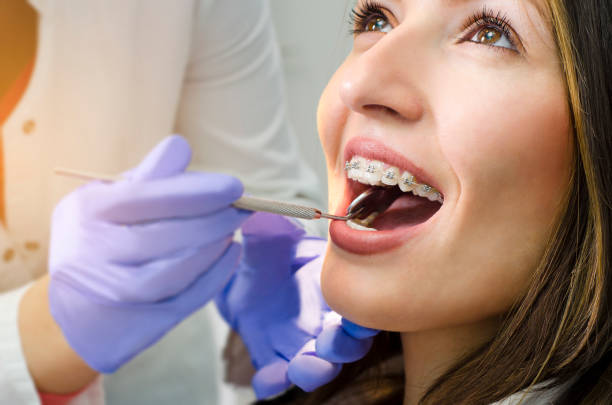 What Are Dental Veneers?