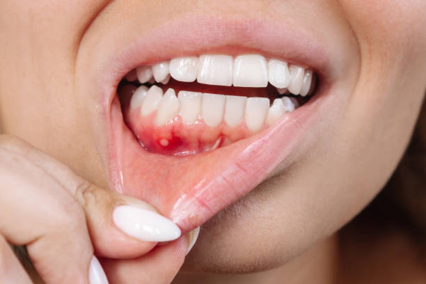 Take These Actions to Avoid Bleeding Gums